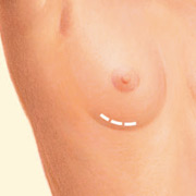 Breast Augmentation Denver CO |Dr. Mouchantat Plastic Surgery
