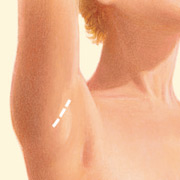 Breast Augmentation Denver CO |Dr. Mouchantat Plastic Surgery