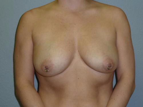 breast augmentation before