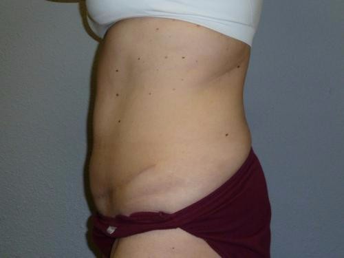 tummy tuck after