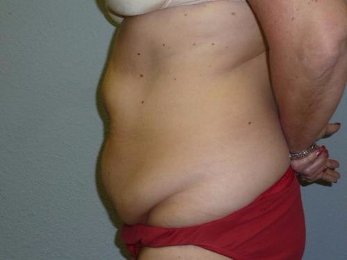 tummy tuck before